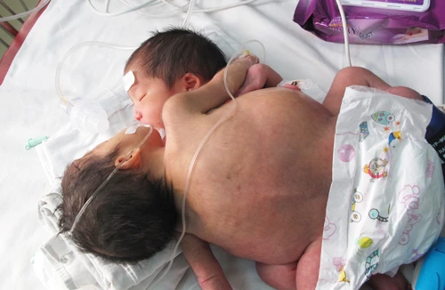 Mổ tạo hình để cứu sống 2 cháu