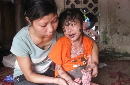 Rơi nước mắt vì cháu bé 9 tuổi bị hàng nghìn khối u quái ác hành hạ