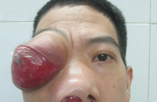 9 năm sống với khối u kỳ quái 