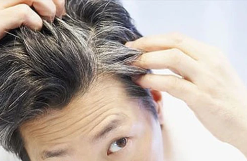 Hiện tượng tóc bạc sớm: Lý giải ở góc độ y khoa