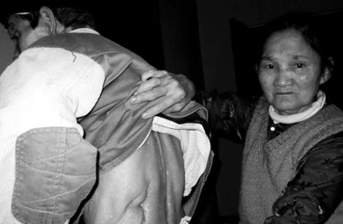 Cụ già dùng dao tự “phẫu thuật” thận 