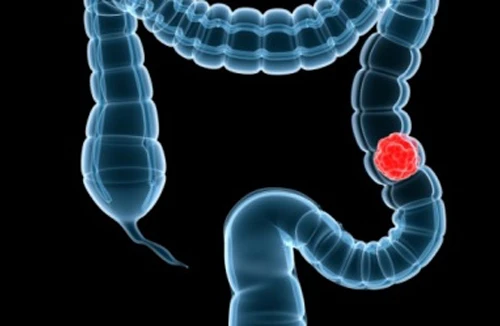 Phòng tránh ung thư ruột kết