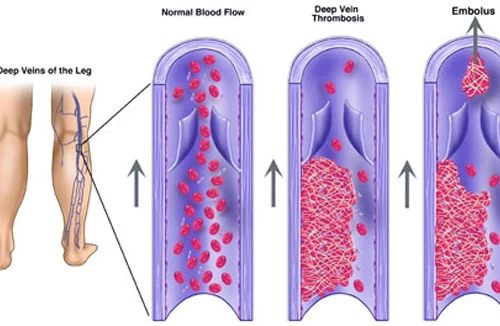 Chân sưng to, coi chừng cục máu đông