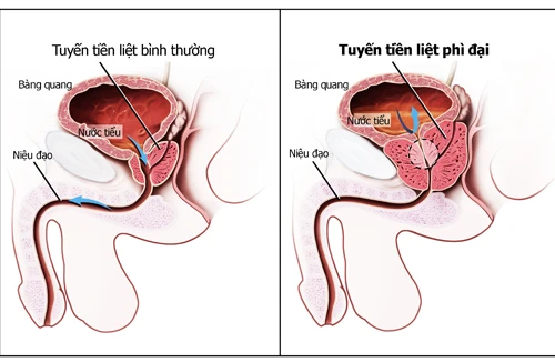 Tiếp sức cho tuyến tiền liệt, cách nào? 