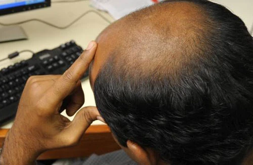Đột phá trong chữa hói đầu