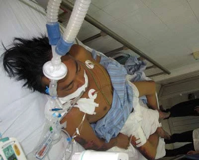 Hà Nội: Bệnh nhân đầu tiên tử vong do nhiễm liên cầu lợn