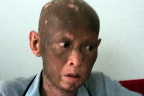 Bình Phước: Bệnh lạ khiến người lột da như rắn