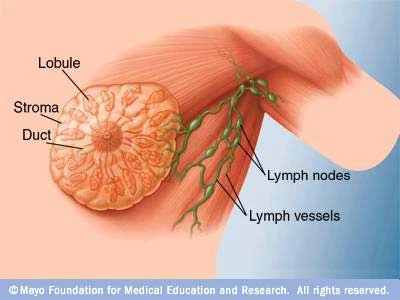 Phụ nữ có tiền sử gia đình bị ung thư vú cần tránh xa rượu