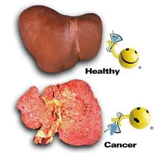 Phát hiện các yếu tố nguy cơ của ung thư gan