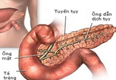 Phát hiện thuốc đích đối với viêm tụy cấp