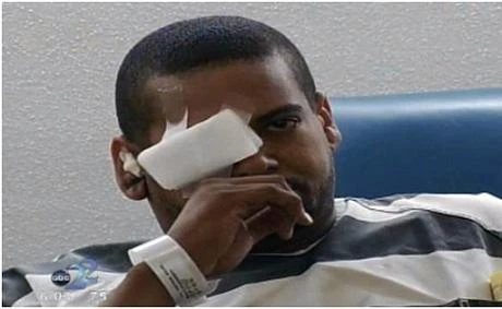 "Dê xồm" bị bắn thủng mắt khi giở trò