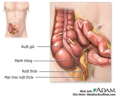 Kháng sinh an toàn và hiệu quả để điều trị viêm ruột thừa
