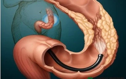 Người béo dễ bị pô-lýp đại tràng