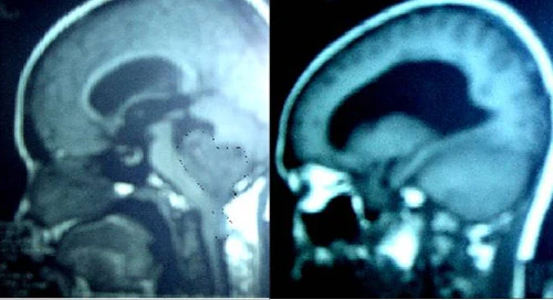 Chụp X-quang răng làm tăng gấp 3 lần nguy cơ u não