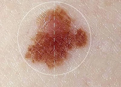 Hút thuốc làm tăng nguy cơ ung thư da