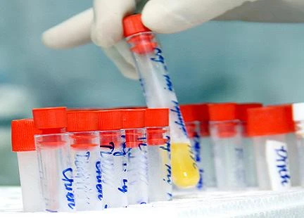 Đoán bệnh qua nước tiểu