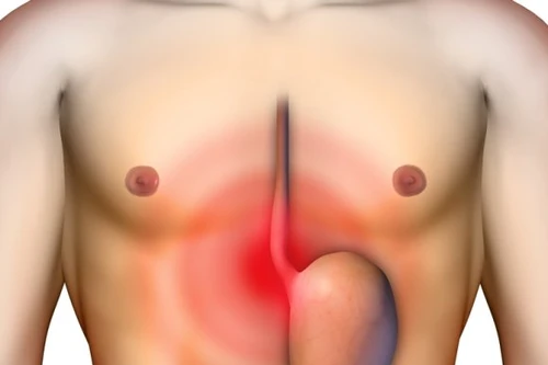 Ợ nóng khiến răng bị mòn