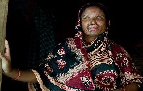 Bị buộc tái hôn với người chồng đã tạt a-xít vào mình