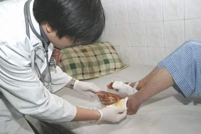 Bệnh nhân loét chân do tiểu đường dễ bị tử vong sớm