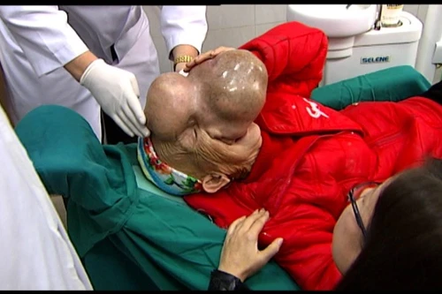 Vỡ mắt, biến dạng toàn bộ khuôn mặt vì mang khối u khổng lồ