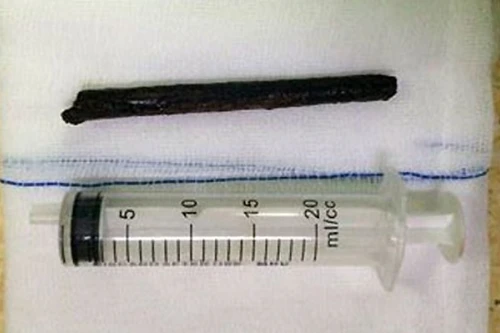 Hải Dương: Uống rượu say đi xe đạp, bị cành cây đâm xuyên hộp sọ