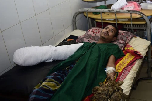 "Người cây" phẫu thuật loại bỏ 5kg "vỏ"