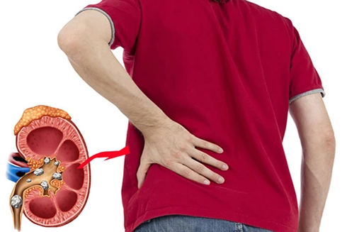 [ẢNH] Những dấu hiệu cảnh báo sớm bệnh sỏi thận bạn nên biết