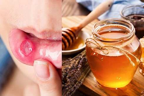 [ẢNH] Những giải pháp tự nhiên giúp điều trị nhiệt miệng cực hiệu quả