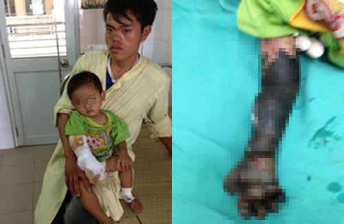 Cháu bé bị hoại tử cánh tay do cha mẹ đắp tro lên vết bỏng