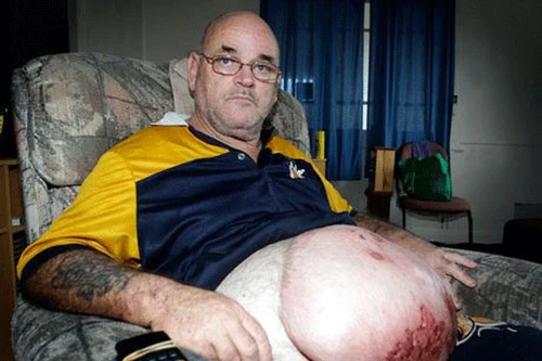 Uống bia bẩn, bụng sưng to như bà bầu!