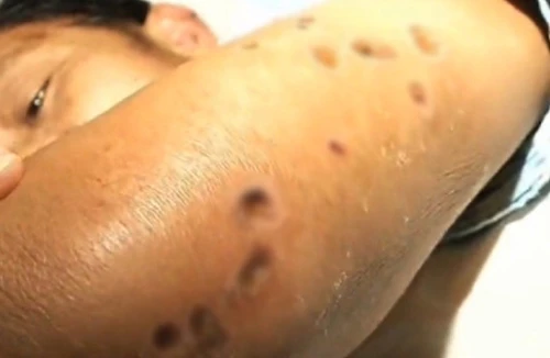 41 người chết, 1.500 người bị thương vì bị ong bắp cày đốt