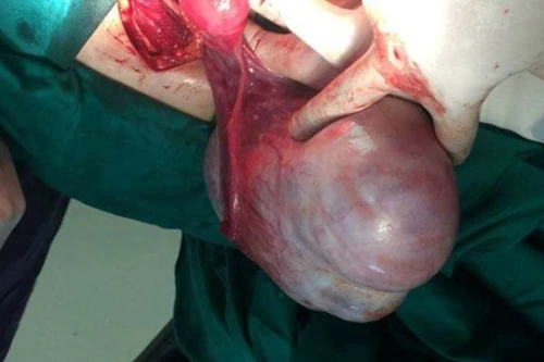 Đi khám vì sốt virus, nữ sinh phát hiện có khối u buồng trứng nặng gần 2kg