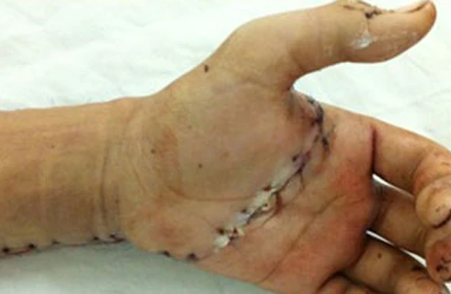 Hãi hùng: Người đàn ông cưa tay, tự sát