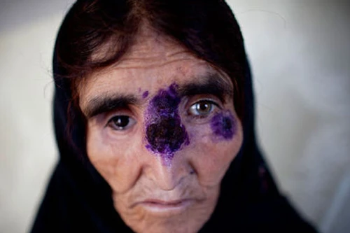 Virus ăn thịt người có thể "đổ bộ" vào châu Âu