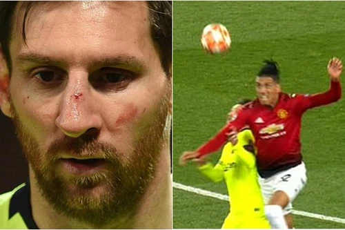 [ẢNH] Sốc với hình ảnh Messi mặt mũi bầm dập sau khi lĩnh đòn của Smalling