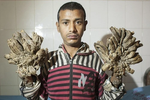 Khốn khổ vì mục cóc biến thành "rễ cây" trên cơ thể 