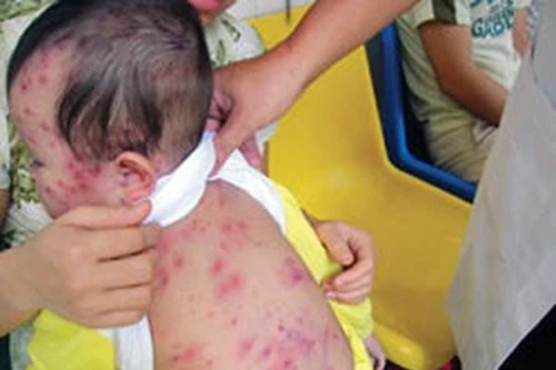 Cập nhật kỹ thuật chẩn đoán sớm giúp phát hiện 80 bệnh tự miễn, dị ứng