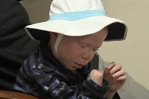 Hãi hùng với nạn "săn" người bạch tạng ở châu Phi