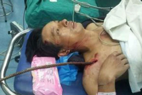 Sống sót dù thanh sắt xuyên qua ngực