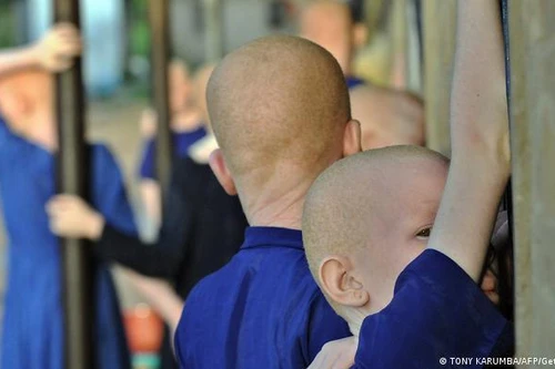 Vụ án làm sáng tỏ định kiến nhằm vào người bạch tạng ở Malawi 