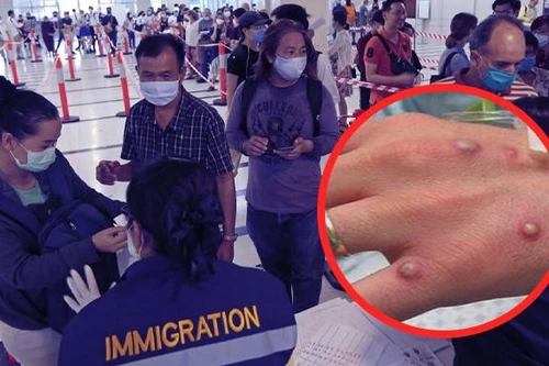 Châu Á báo động cao về bệnh đậu mùa khỉ 