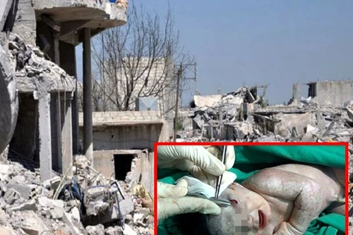 Giây phút cứu sống em bé bị mảnh bom găm vào trán ngay trong bụng mẹ 