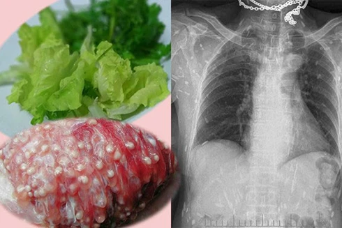 [ẢNH] "Tránh xa" những món ăn tiềm ẩn nhiều nguy cơ mắc bệnh giun, sán