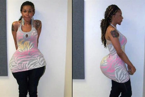 Bắt giữ bác sĩ rởm bơm mông bằng những hợp chất quái dị