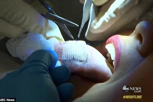 Giảm 9kg trong vòng 30 ngày nhờ khâu gạc vào lưỡi