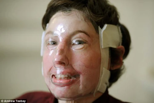 Sống sót thần kì sau khi bị bỏng 96% cơ thể 