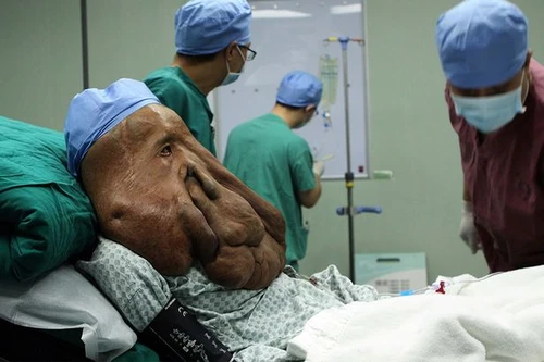 Người đàn ông khổ sở với khối u 17.5 kg trên mặt