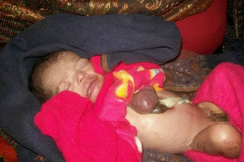 Bé sơ sinh chào đời với trái tim nằm ngoài lồng ngực 