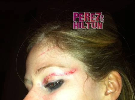 Hé lộ bức ảnh về thương tích của Avril sau ẩu đả