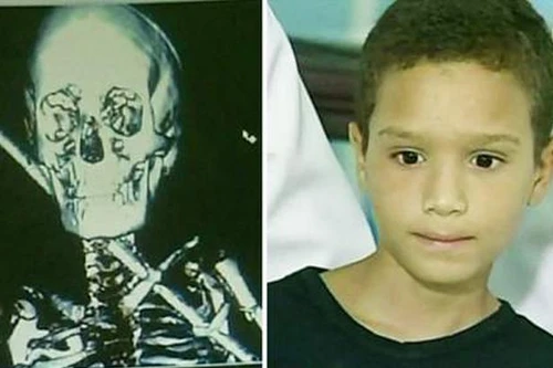 Vẫn sống sót dù bị thanh sắt 60 cm đâm xuyên người 